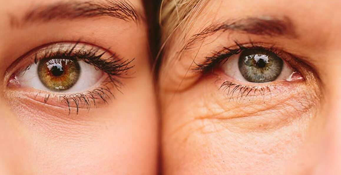 External signs of aging skin around the eyes in two women of different ages