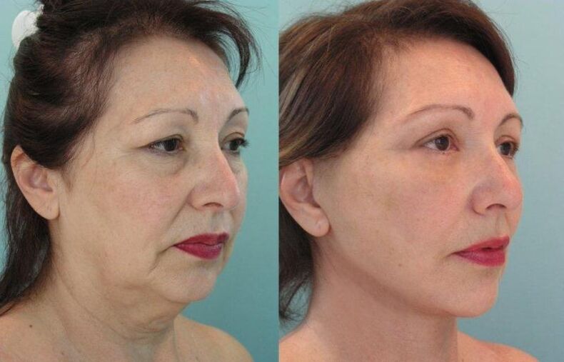 The result of rejuvenating facial skin tightening with threads