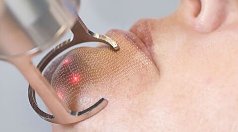Course of procedure for fractional laser skin rejuvenation