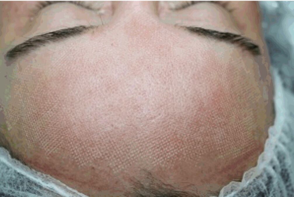 Slight redness and swelling of the skin after fractional laser
