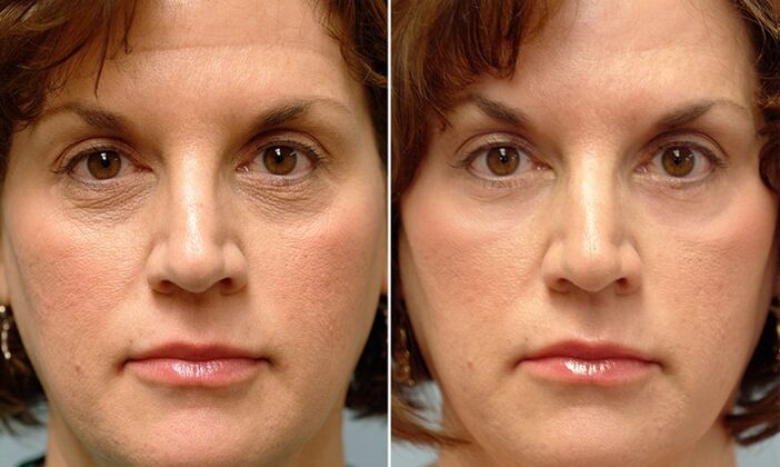 face before and after fractional laser rejuvenation