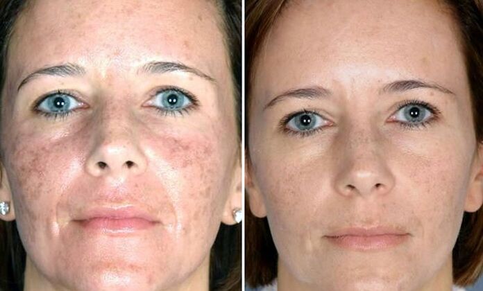 photo before and after fractional laser rejuvenation