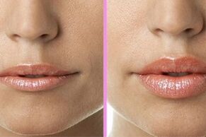 before and after the lip restoration procedure